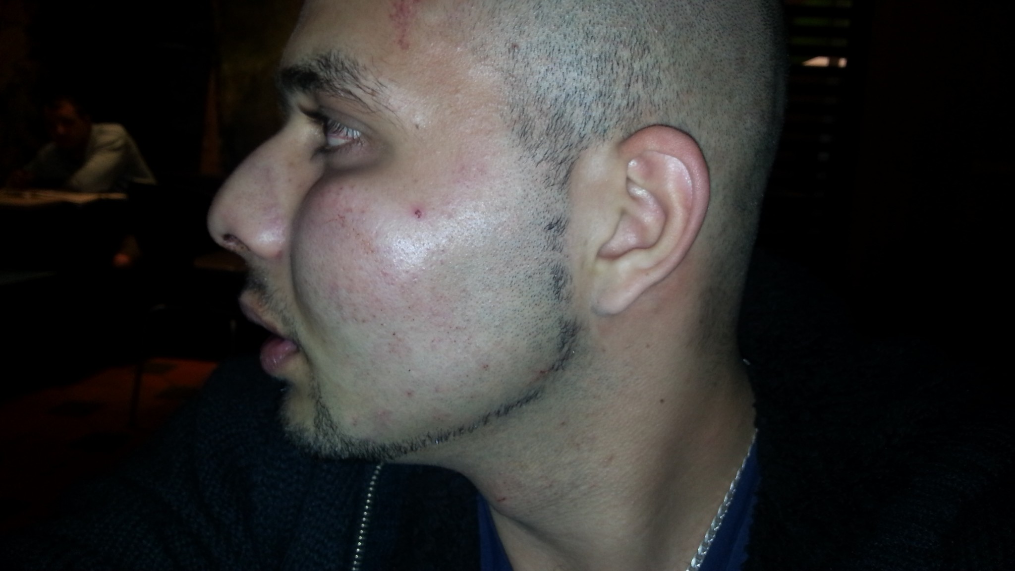 JUSTITS: Racistisk overfaldsmand brækkede hans næse. Politiet kvitterede med en bøde